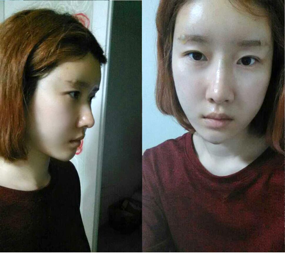 1일후-.jpg