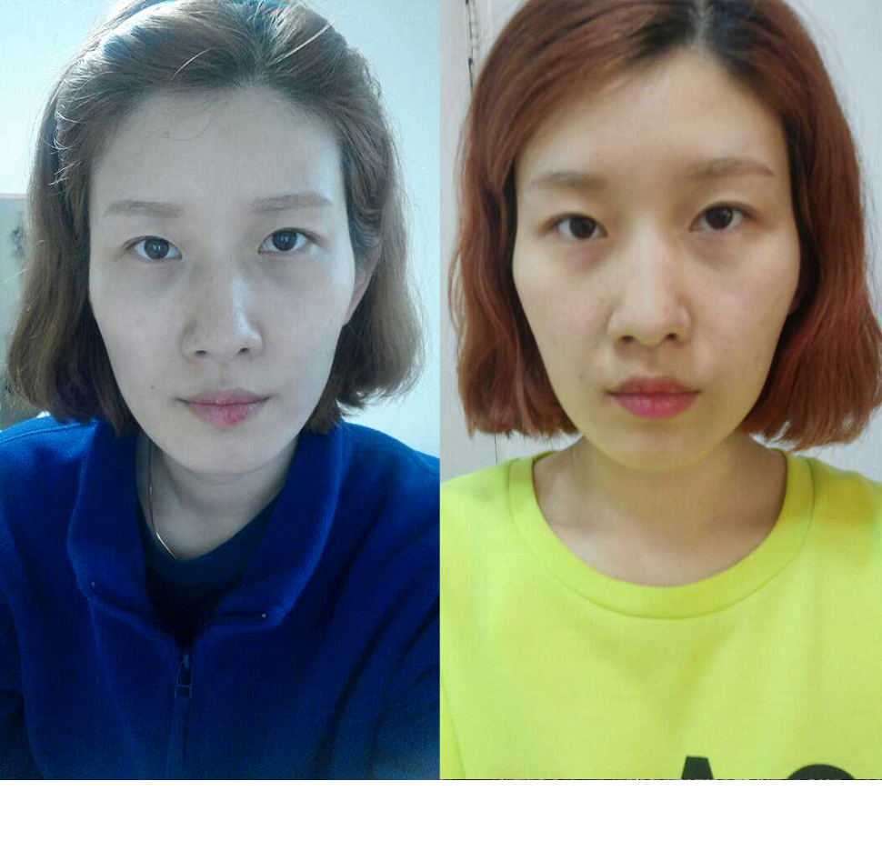 2수술전.jpg