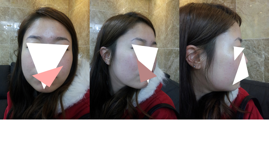 141027_이지연_나노지방이식_전.jpg