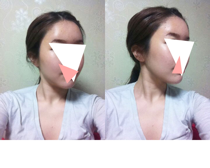 141027_이지연_나노지방이식_후2.jpg