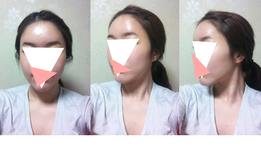 141027_이지연_나노지방이식_후.jpg