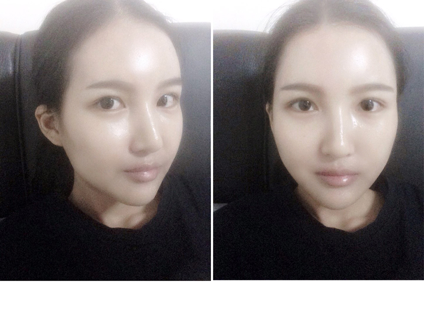 수정_수술후한달.JPG