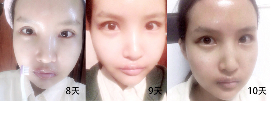 수정_수술후8,9,10일.JPG
