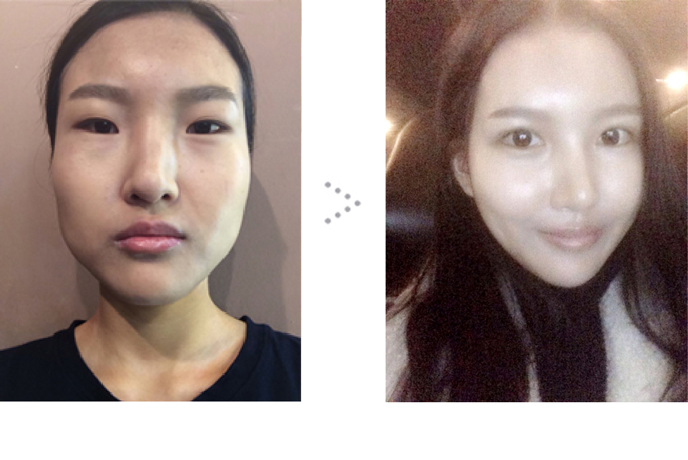 수정_수술전후 (2).JPG