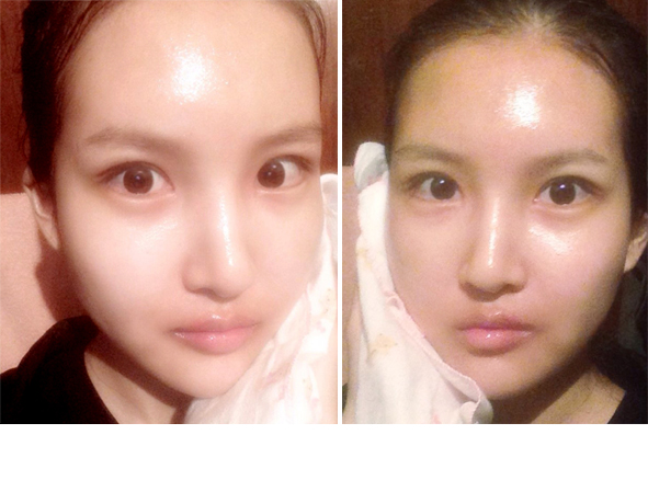 수정_수술후3주.JPG
