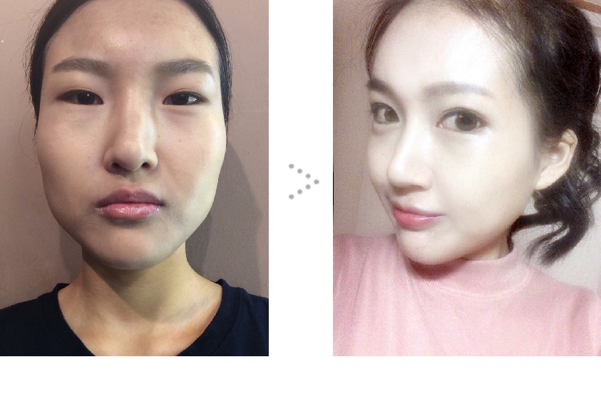 수정_수술전후.JPG