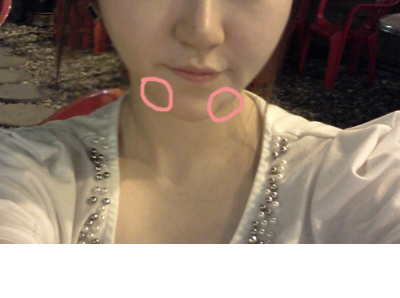 141209_박정화_수술후4일.JPG