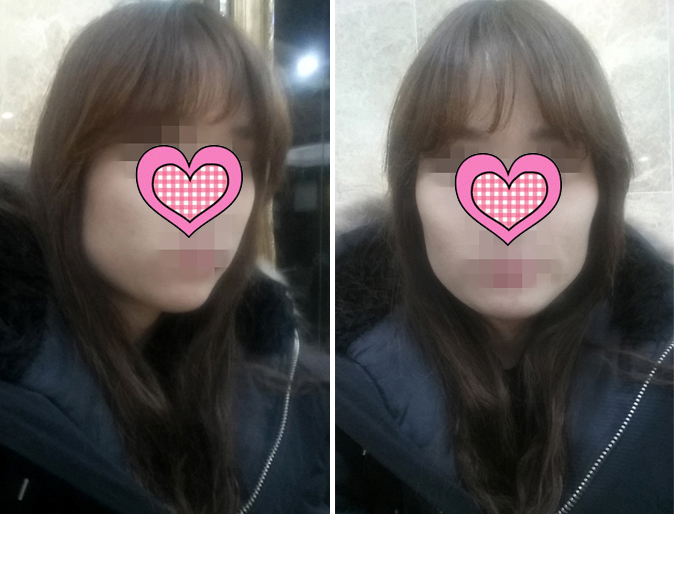 141212_서유경_돌려깎기_수술전_포스팅(2).JPG