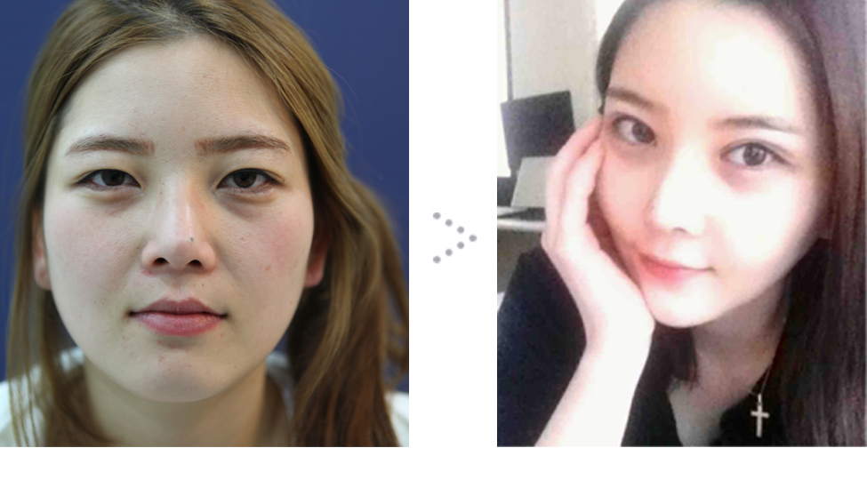 141212_박소영_수술전후_포스팅.JPG