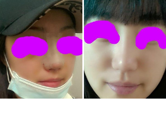 141217_코수술_후_포스팅.JPG