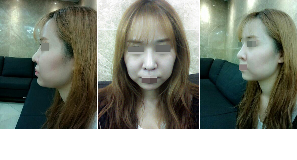 노예나_수술전.JPG