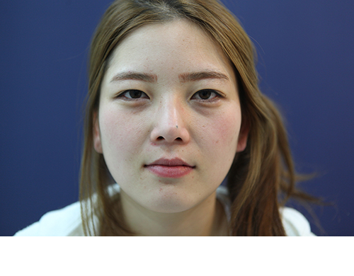 워터마크141215_박소영_수술전_포스팅.JPG