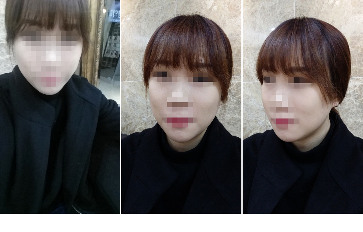 141212_서유경_돌려깎기_수술후_포스팅.JPG