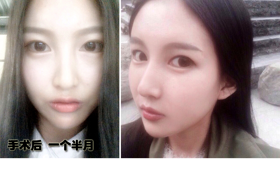 141230_전민지_수술후한달반_포스팅.JPG