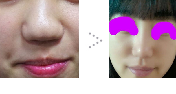 141217_코수술_전후_포스팅.JPG