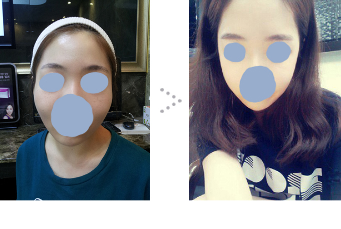 141211_강혜지_광대축소_전후.JPG