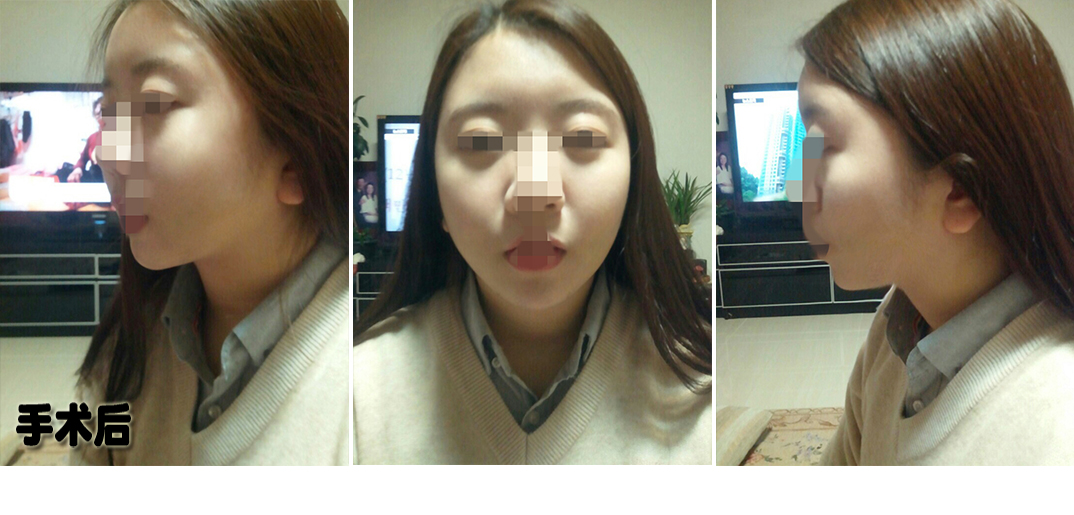 수술 후.jpg