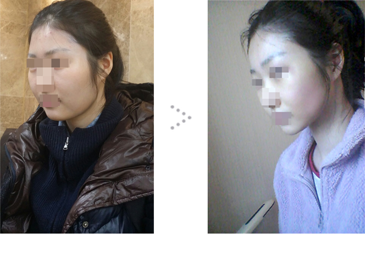 141209_박차린_나노브이_수술전후.JPG