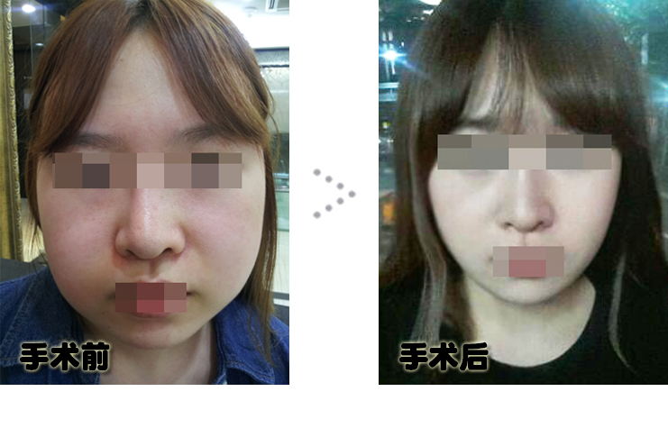 150106_심선진_나노_전후_포스팅.JPG