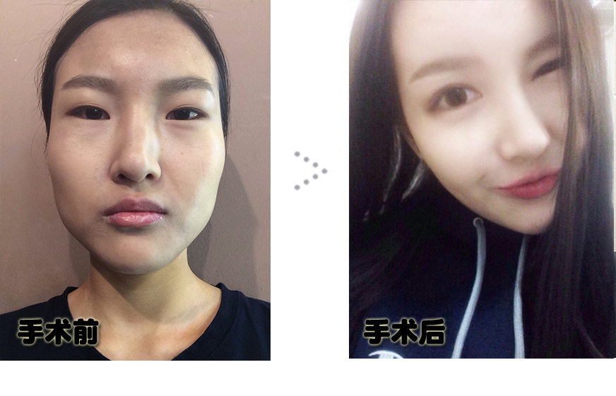 전후_3개월.jpg
