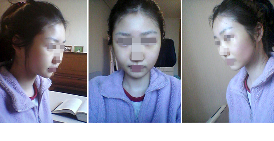 141209_박차린_나노브이_수술후7일1.JPG