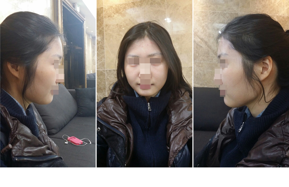 141209_박차린_나노브이_수술전2.JPG