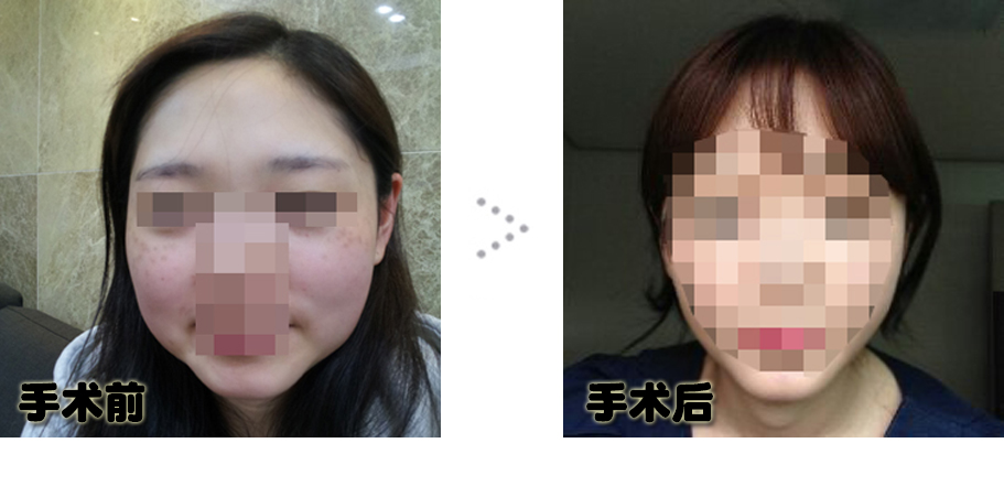 141231_원예지_나노_전후_포스팅.JPG