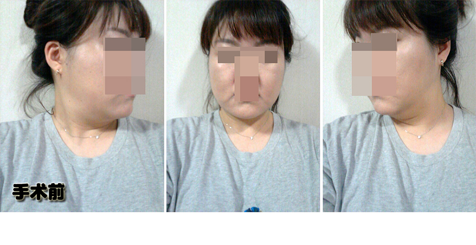 수술 전.jpg