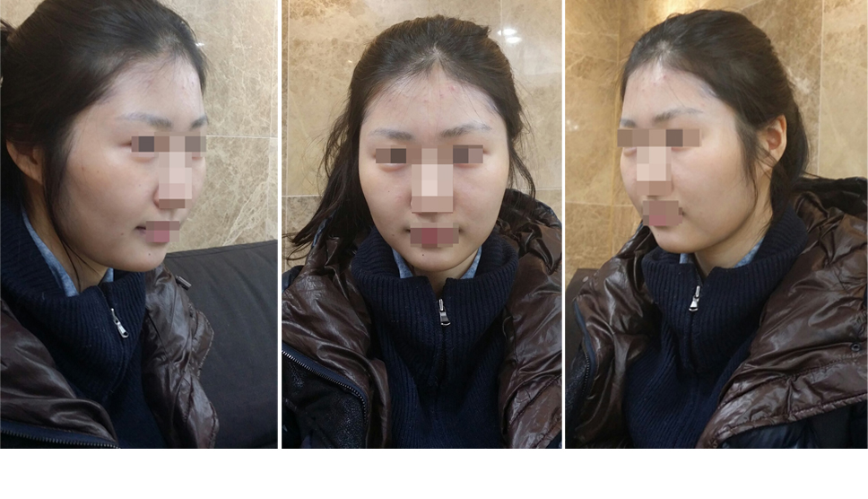 141209_박차린_나노브이_수술전1.JPG