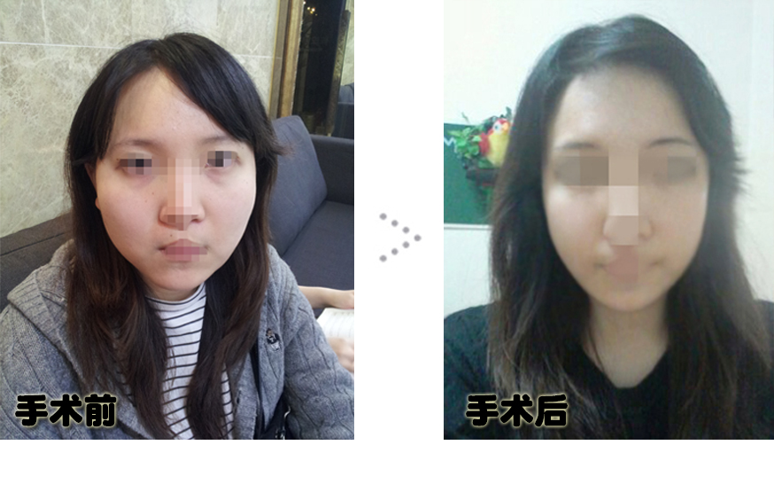 150105_김미진_나노_전후_포스팅.JPG