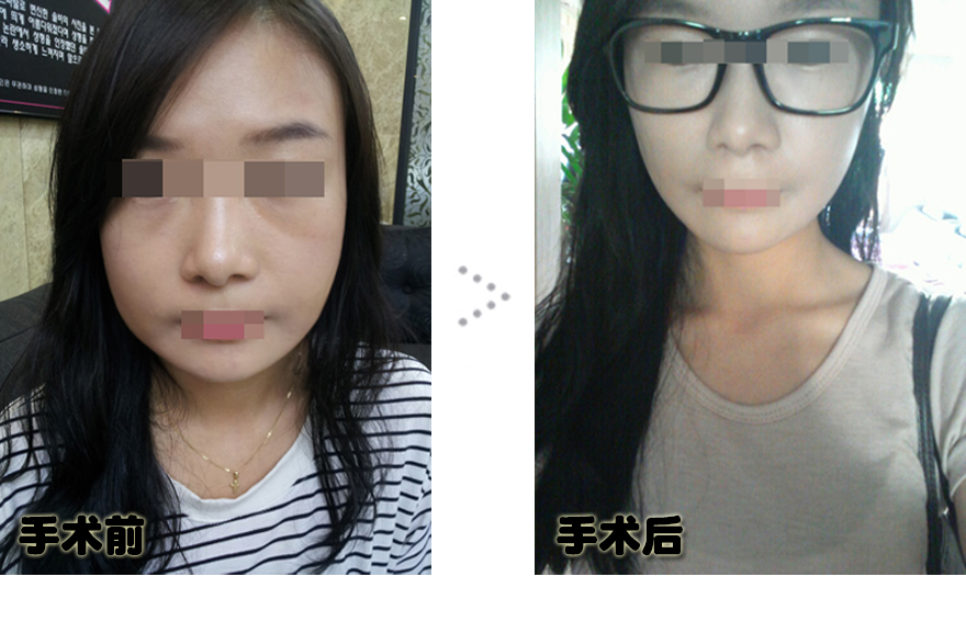 141231_이소영_나노,눈밑지방_전후_포스팅.JPG