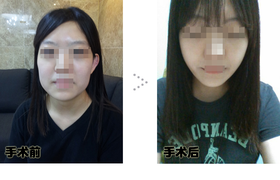 150106_이수경_나노_전후_포스팅.JPG