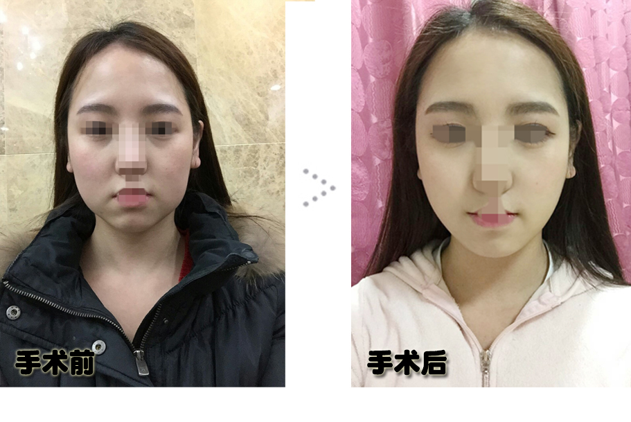 141230_조미희_나노_전후_포스팅.JPG