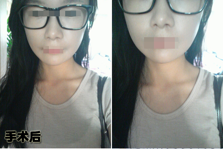 141231_이소영_나노,눈밑지방_후_포스팅.JPG