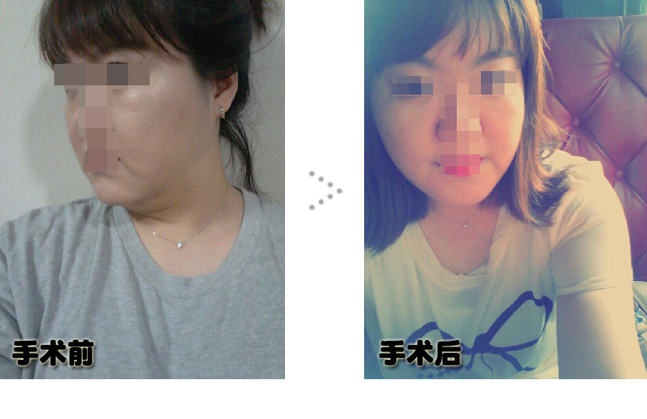 150120_김보라2_나노브이_전후_포스팅.JPG