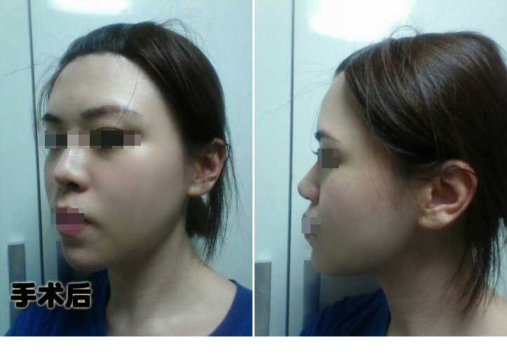 141231_김지선_나노_후_포스팅.JPG
