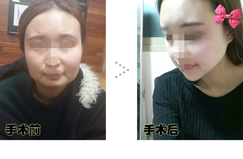 1전후_포스팅.jpg