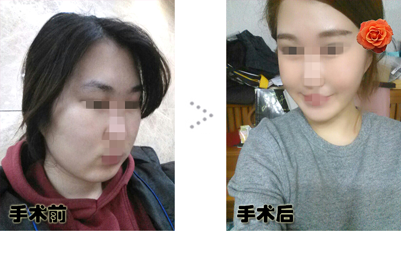 임노엘_전후.jpg