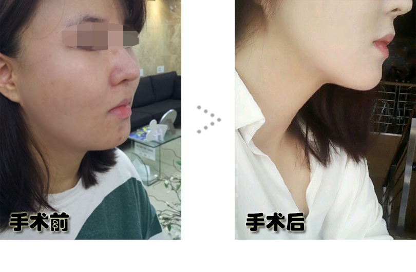 함유선_전후.jpg