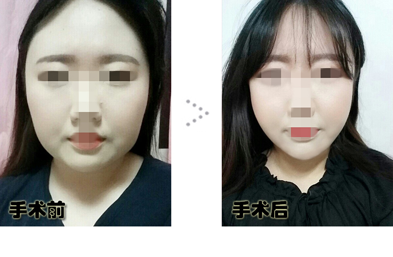 정미희_전후.jpg