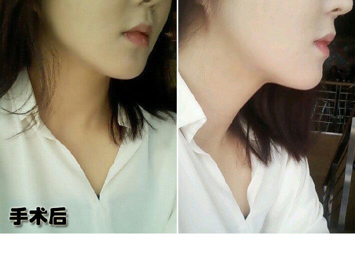 함유선_후.jpg