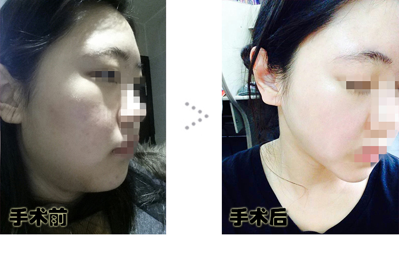 임효선2_전후.jpg