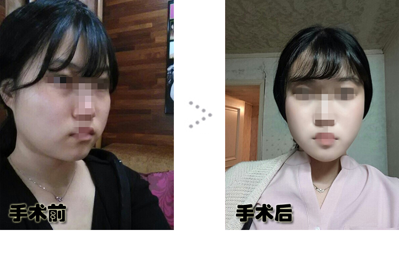 강민아-전후.jpg