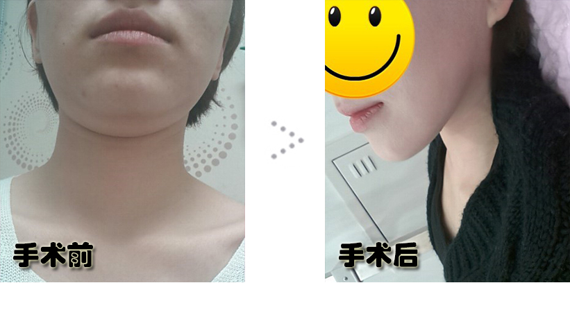 나노이름없음_전후.jpg