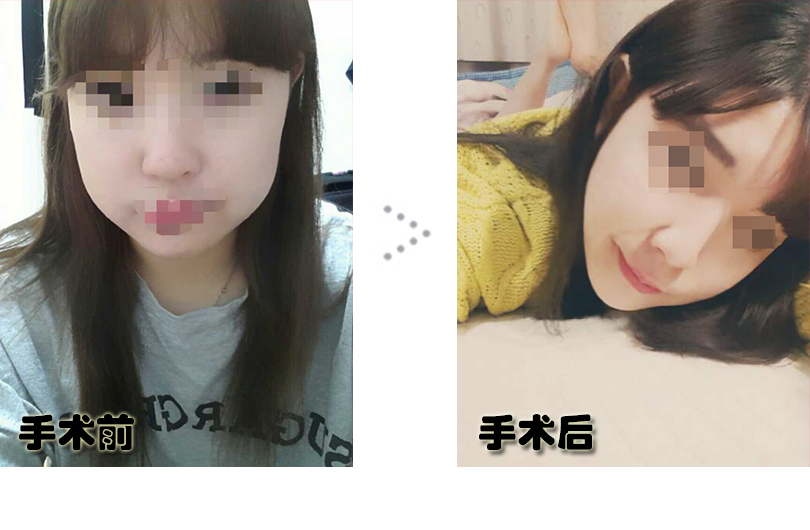 권민서 전후.jpg
